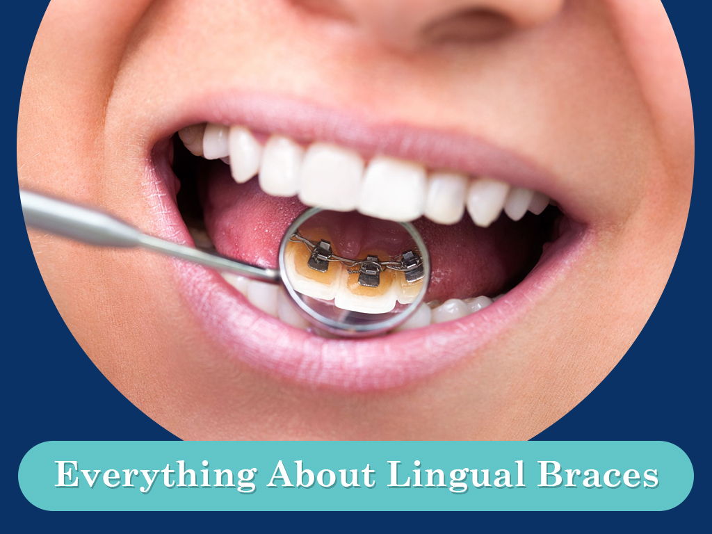 Things to Know About Lingual Braces