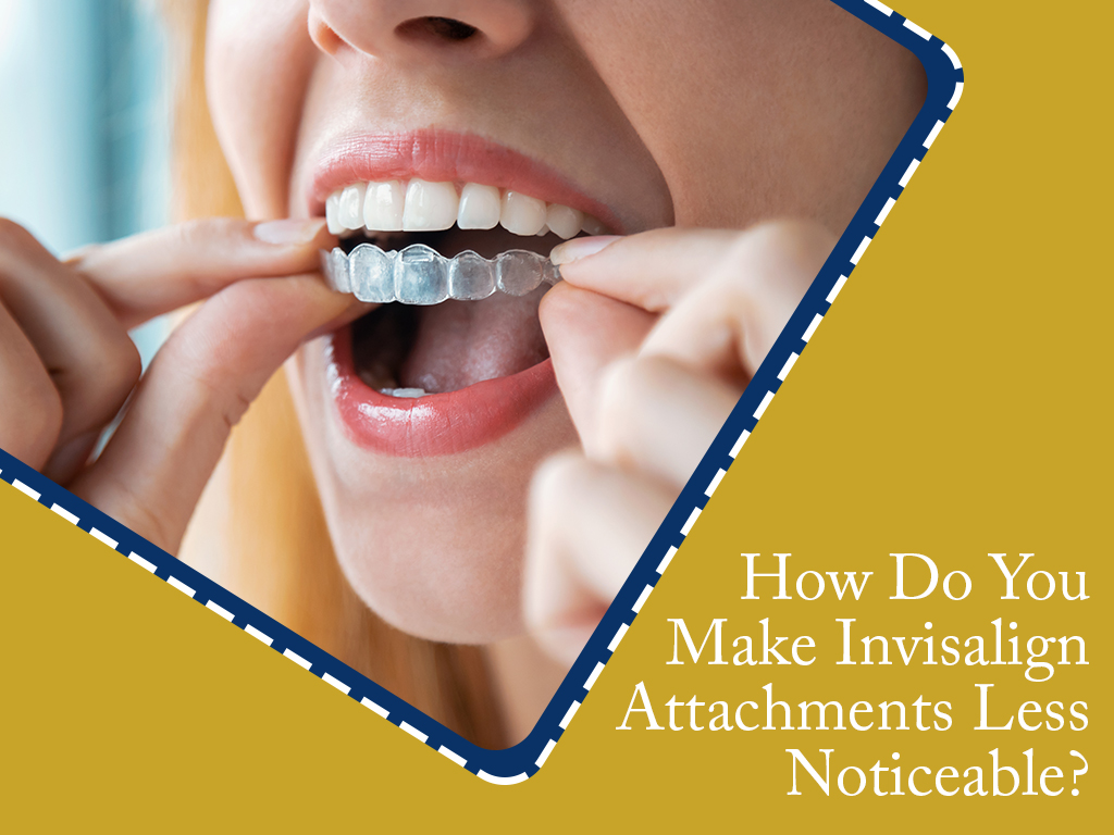 Invisalign Attachment: How to Make it Less Obvious